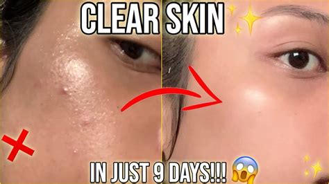 Clear Pimples In Just 9 Days Effective Skincare Hack Thats Not A