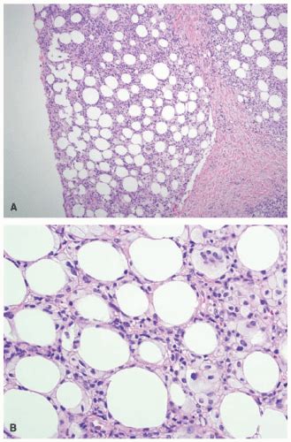 Panniculitis Granulomatous And Fibrosing Disorders Plastic Surgery Key