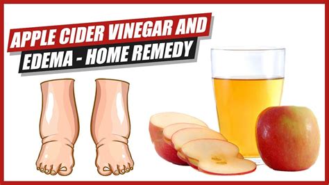 Apple Cider Vinegar And Edema Home Remedy Youtube