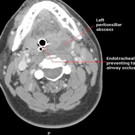 Computer Tomography Ct Scan Of Neck Left Peritonsillar Abscess