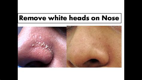 Turmeric To Remove White Heads On Nose Starnaturalbeauties Youtube