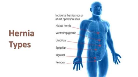 Femoral Hernia Symptoms Men Hernias And Groin Swellings Most