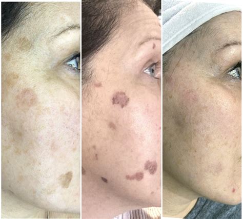 What To Expect After Laser Treatment On Your Face From A Laser Expert
