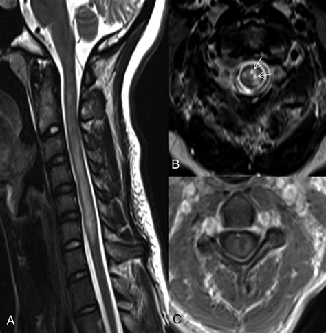 MRI Predictors Of Recurrence And Outcome After Acute Transverse