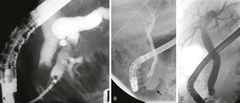 Endoscopic Retrograde Cholangiopancreatography Radiology Key