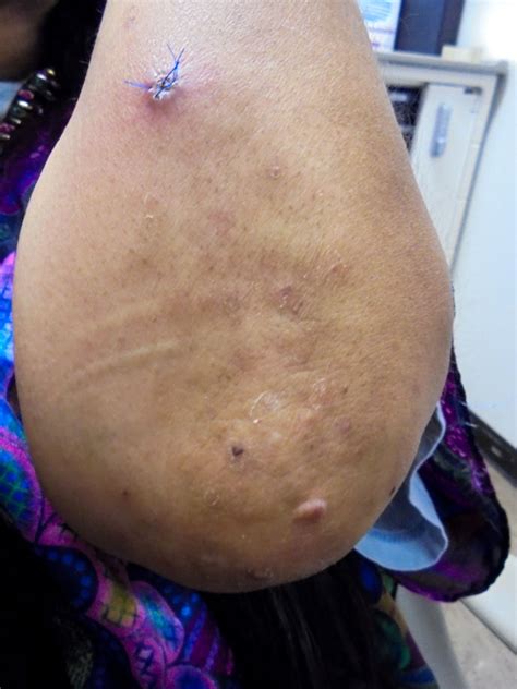 Palisaded Neutrophilic Granulomatous Dermatitis With Concomitant