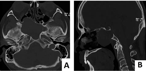 Figure 1 Axial Ct Scan Showed Remodeling Of The Sphenoid Sinus Wall