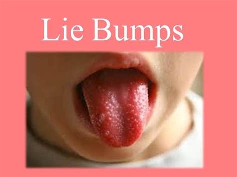 Jun 12, 2021 · transient lingual papillitis, also known also as lie bumps, is a temporary inflammation of the tongue's papillae. Lie Bumps - YouTube