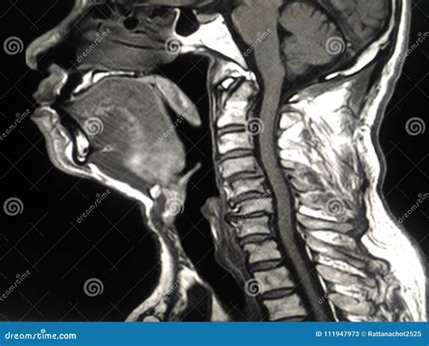 Mri Cervical Spine Stock Image Image Of Anatomy Bone 111947973