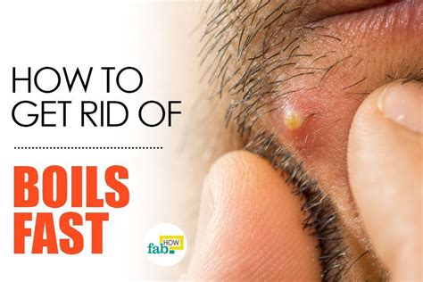 How To Get Rid Of A Boil Fast With Home Remedies Skin Natural