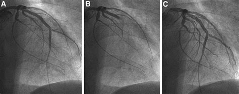 Severe Endothelial Dysfunction After Sirolimus Eluting Stent