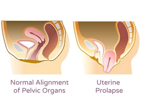 What Are The Early Symptoms Of Uterine Prolapse