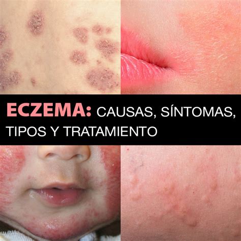 Eczema Causas Tipos Síntomas Y Tratamiento La Guía De Las Vitaminas