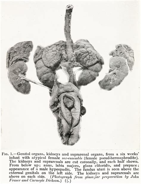 On The Atypical Male And Female Sex Ensemble So Called Hermaphroditism