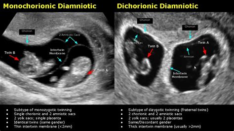 Fetal Twins Ultrasound Normal Vs Abnormal Monochorionicdichorionic