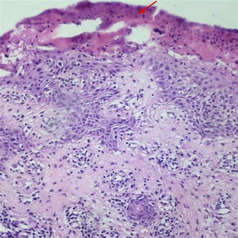 Necrolytic Migratory Erythema A Skin Lesions Affecting Pretibial