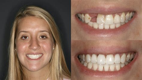 Teeth Veneers Before And After