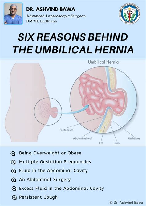 Some hernias are asymptomatic during pregnancy. Pin on Hernia Awareness