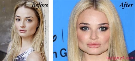 Emma Rigby Plastic Surgery Photos Before And After ⋆ Surgery4