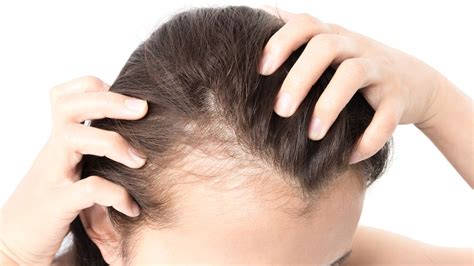 Proteinmangel Kann Zu Haarausfall Führen