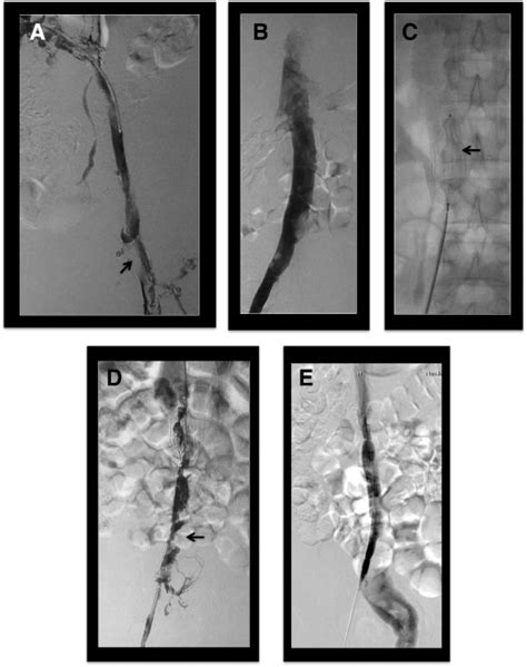 Etiology And Treatment Of Acute Inferior Vena Cava Thrombosis