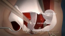 Chirurgie du nez Rhinoplastie Docteur Dombard Overijse Bruxelles - YouTube
