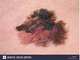 Images of Superficial Spreading Melanoma Treatment