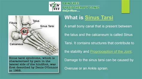 Causes Of Sinus Tarsi Syndrome Pain Free Physiotherapy Clinic By Pain