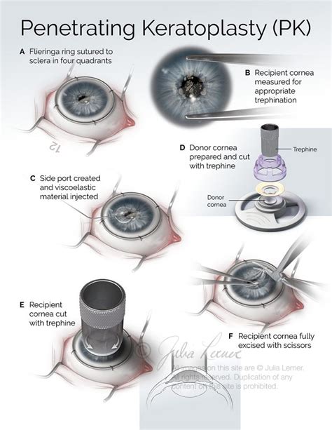Penetrating Keratoplasty Pk Corneal Transplant Eye Facts Eye Surgery