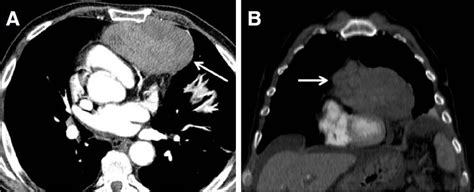 Axial Contrast Enhanced Computed Tomography Ct Slice A And Coronal