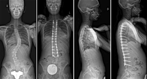 Commonly Performed Scoliosis Surgeries Before And After—1cn Michael G