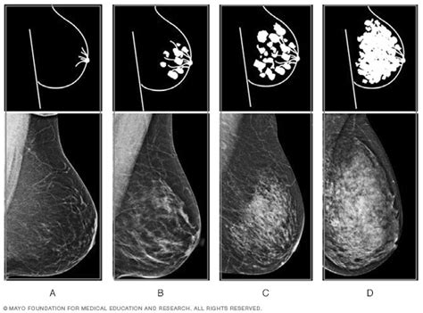 Tissu Mammaire Dense Ce Que Signifie Avoir Des Seins Denses Les