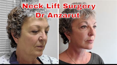 Neck Lift Surgery Explained Everything You Want To Know About Neck