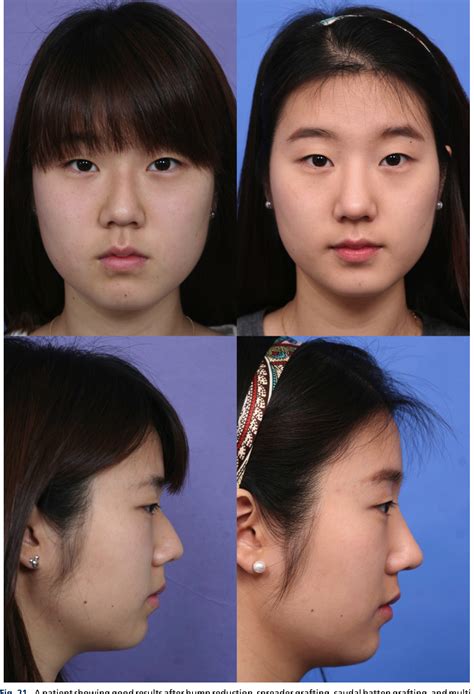 Figure 21 From Rhinoplasty In The Asian Nose Semantic Scholar