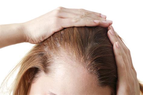 What To Know About Telogen Effluvium Riviera Hair Replacement