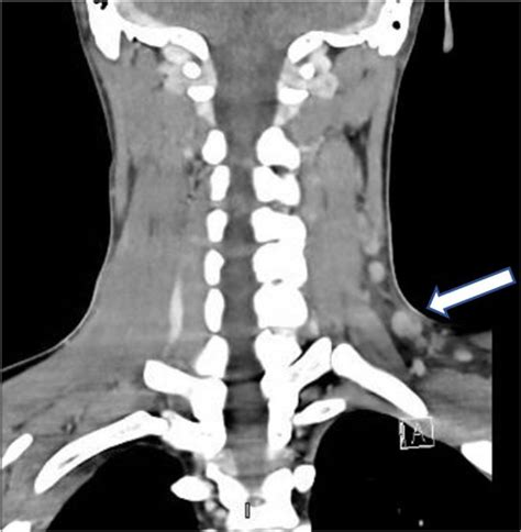 Ct Of The Neck Demonstrating Left Multiples Supraclavicular