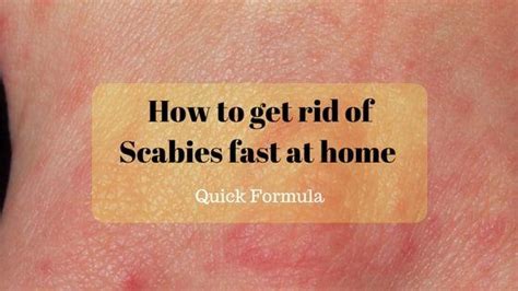 How To Get Rid Of Scabies Fast At Home Quick Formula Home Remedies