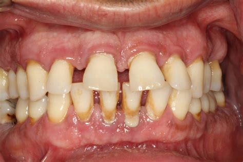 NEW STUDY LINKS GUM DISEASE AND COVID‐19 COMPLICATIONS - Britten Perio