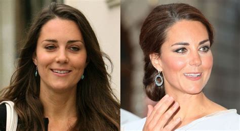 Kate Middleton The Duchess Of Cambridge And Plastic Surgery