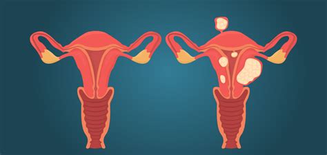 Qué son los miomas uterinos Te contamos lo que debes saber GINECOM