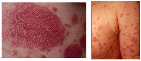 What Does Psoriasis Look Like