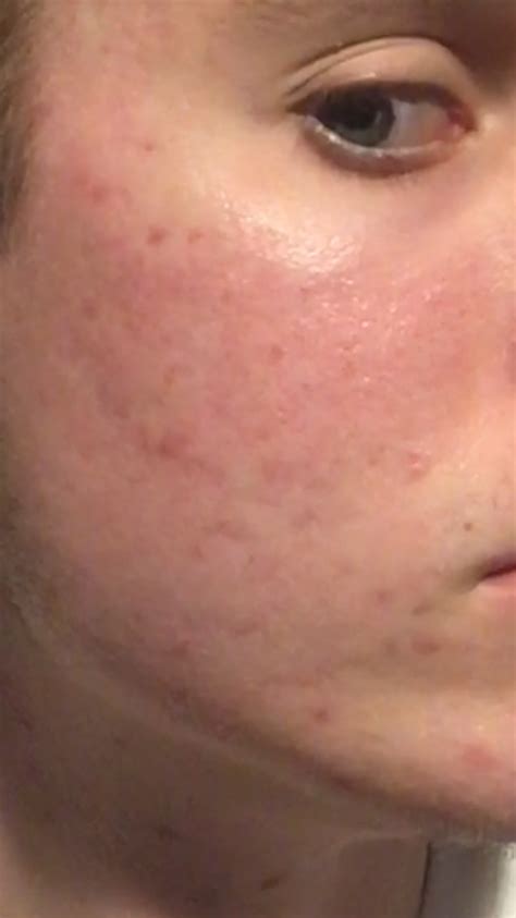 Red Acne Marks On My Face Forever Hyperpigmentation Reddark Marks