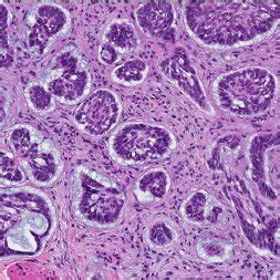B Histology Of Basal Cell Carcinoma Download Scientific Diagram