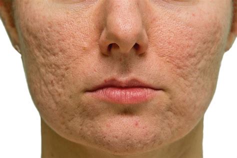 How To Get Rid Of Old Acne Scars Completely Useful Tips To Follow