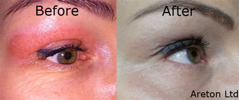 Eyelid Tightening Voltaicplasma Areton Ltd