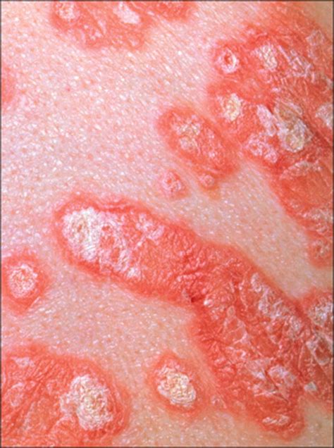 Ponesimod—a Future Oral Therapy For Psoriasis The Lancet