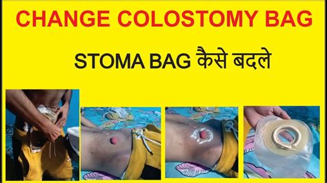 Stoma Bag Change Colostomy Bag Change Ostomy Bag Change Youtube