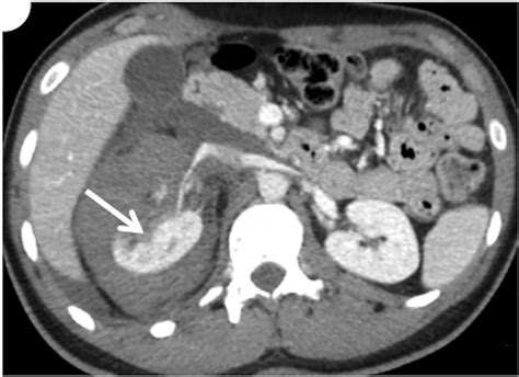 A Shattered Kidney A Pitfall In Imaging Of Renal Trauma Bmj Case Reports
