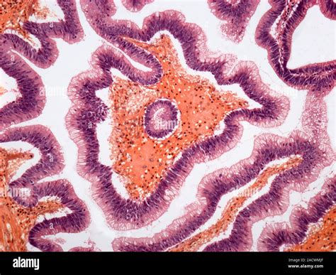 Colon Poly Light Micrograph Of A Section Through A Villous Adenomatous