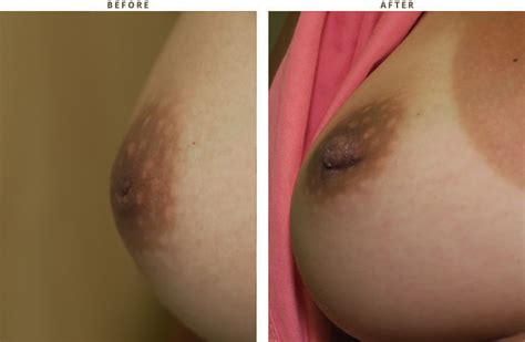 Inverted Nipple Before And After Pictures Dr Turowski Plastic